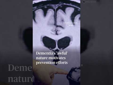 Dementia's 'awful' nature motivates prevention efforts