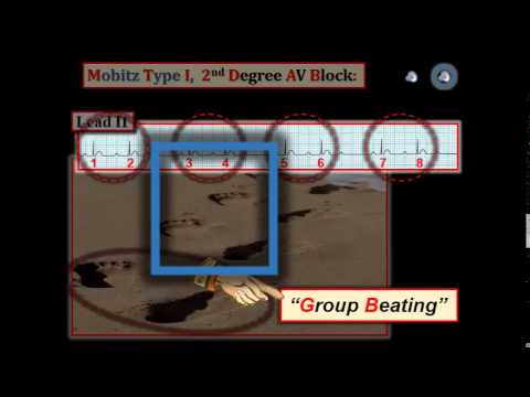 ECG Video-8 (Blog 105) - AV Block (1-25.1-2015)