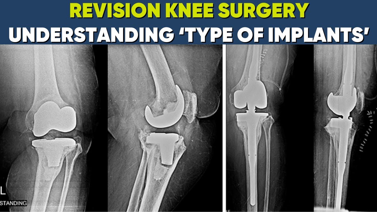 Are revision knee replacements successful? Know about Revision knee implants and much more ..