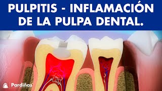 Pulpitis - Inflamación de la pulpa dental © - Clínica Dental Pardiñas
