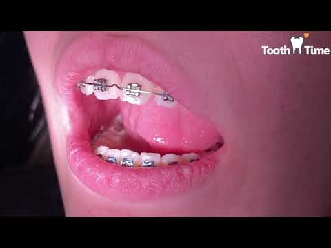 Braces Checkups - back track wire - Tooth Time Family Dentistry New Braunfels