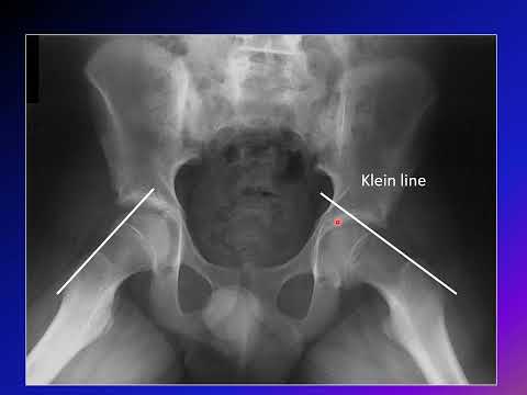 Slipped Capital Femoral Epiphysis (SCFE)
