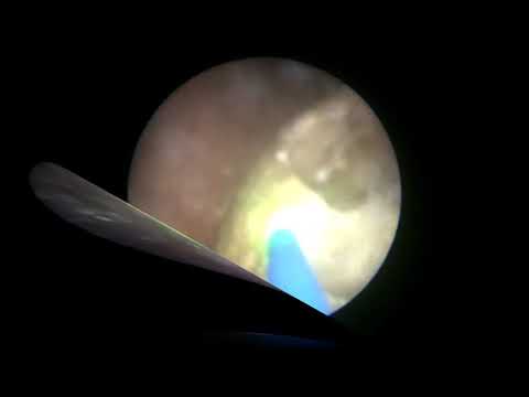 Holmium Laser Lithotripsy of Bladder Stone