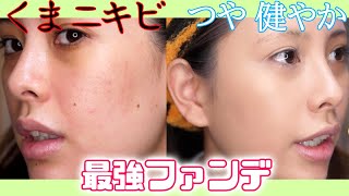 クマ、ニキビに悩み続けた私が感動したファンデ！