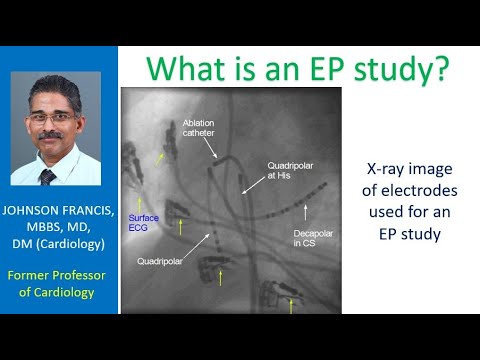 What is an EP study?
