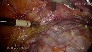 Cervical Myoma Hysterectomy