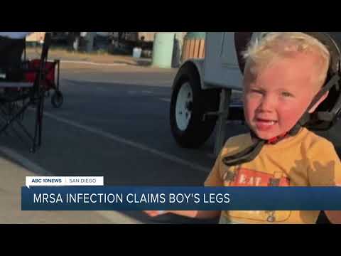MRSA staph infection claims 3-year-old boy's legs during family vacation