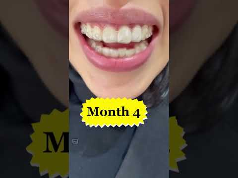 Invisalign Journey #shorts