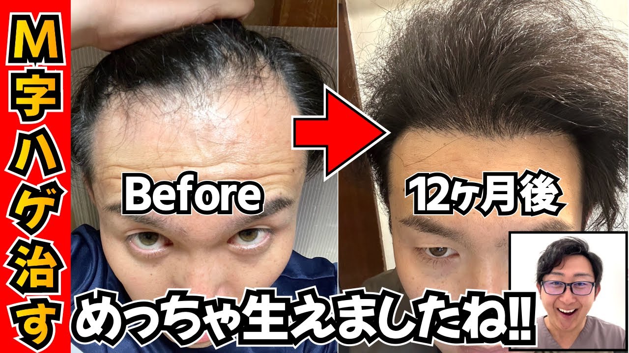 【M字ハゲ治す】生え際に植毛。薄毛にならない毛を生え際に引っ越し【自毛植毛｜体験談】