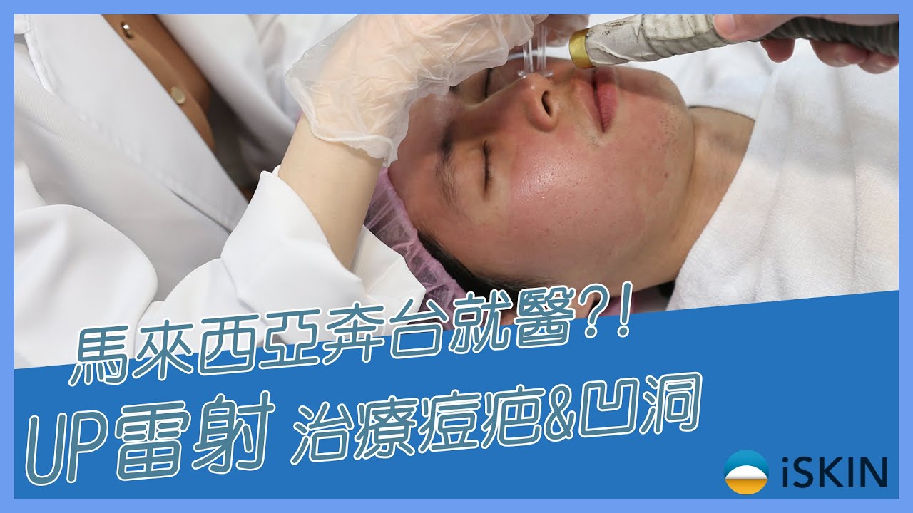【UP雷射】從馬來西亞奔台求醫？！痘疤、凹洞治療全紀錄！