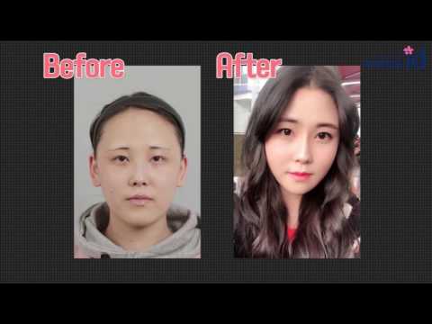 Korean girl undergoing v line surgery, cheekbone reduction, and hairline surgery!