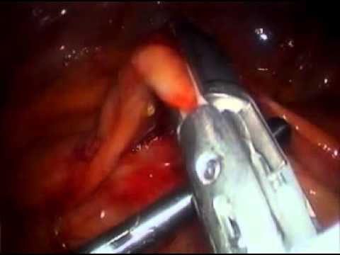 Hemikolektomia prawostronna laparoskopowa