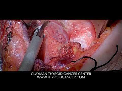 Total Thyroidectomy and Central Neck Dissection