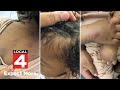 Detroit mom says 1-year-old bitten and bruised at child care center