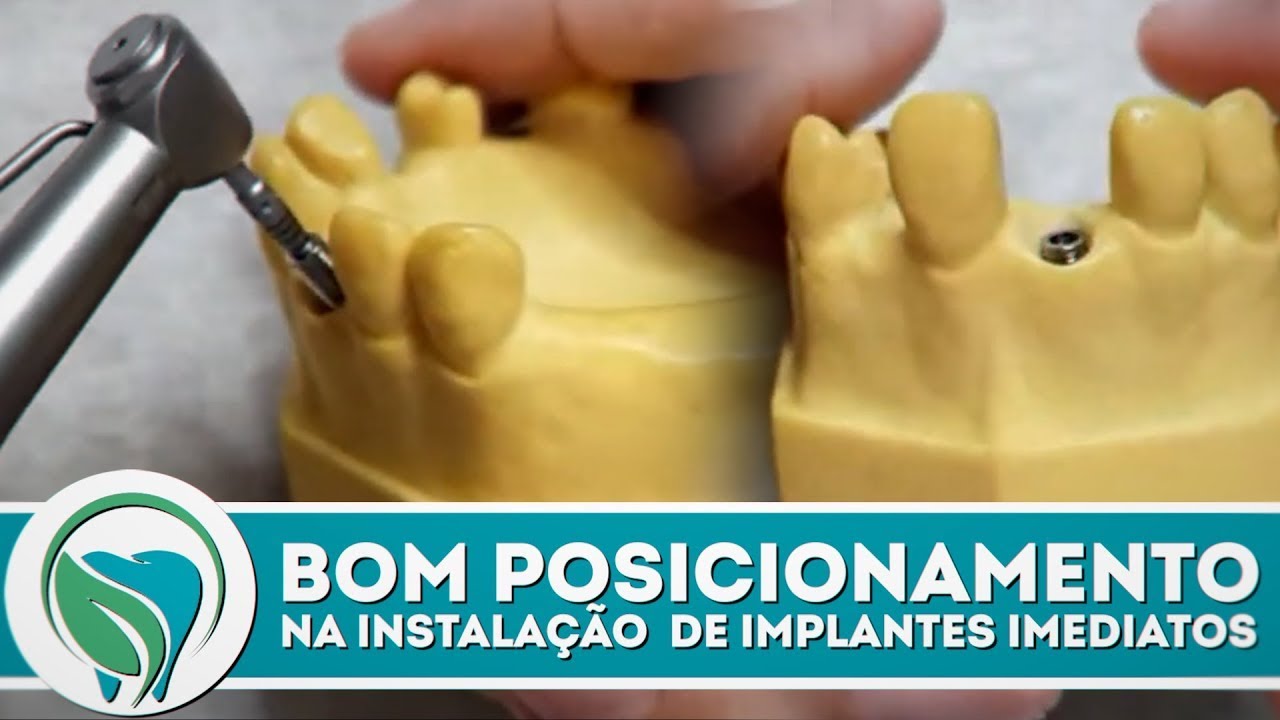 Garantindo um bom posicionamento na instalação de implantes imediatos