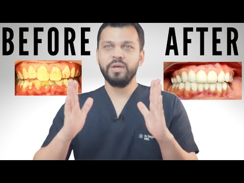 Dentist Explains Smile Makeover — Cost, Crowns, Veneers