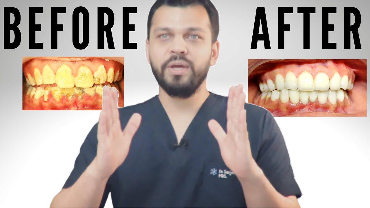Dentist Explains Smile Makeover — Cost, Crowns, Veneers