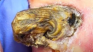 Super Thick Onychomycosis, As Thick As A Mountain【Xue Yidao】
