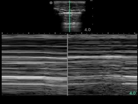 No Lung Sliding with M Mode Linear Transducer