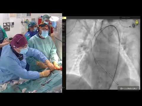 TAVI Procedure Using MYVAL Balloon Expandable 26MM And Predilation With A 23 MM Balloon