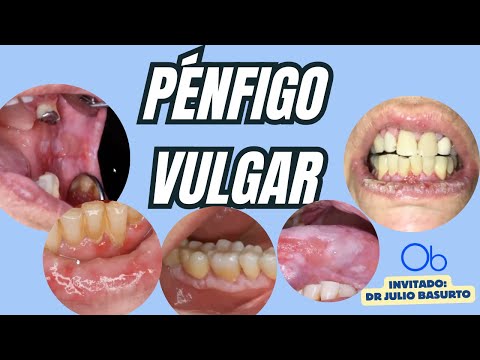 Pénfigo Vulgar