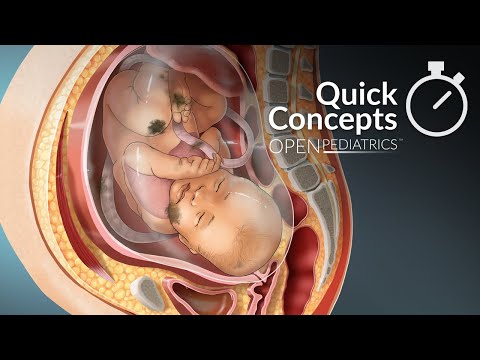 Meconium Aspiration Syndrome by M. Connelly, A. Erickson, L. Rubin | OPENPediatrics