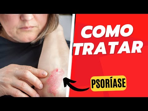 Melhor tratamento para psoríase