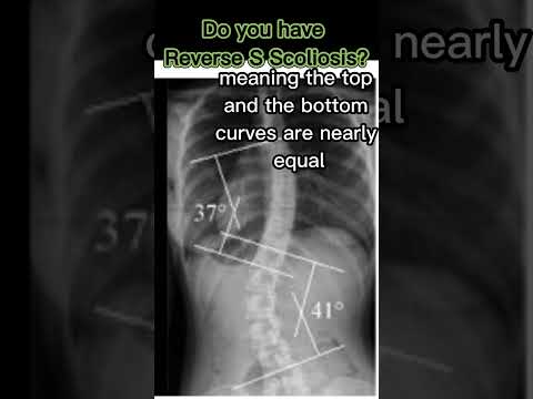 Reverse S scoliosis #shorts #scoliosis #backpain