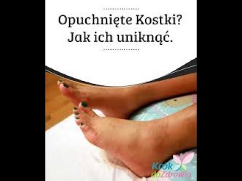 Koślawe stopy, co to jest W zgięciu guz palca