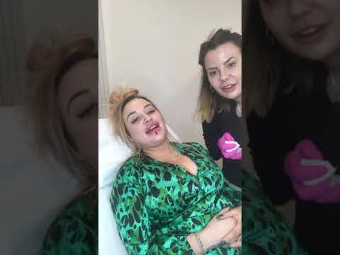 Lips  Nasolabials Filler Treatment