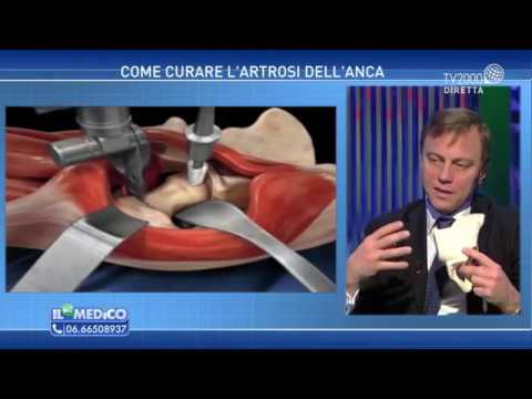 Intonaco per giunti Dikulja Perché gomito dolorante