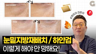 눈밑지방재배치VS하안검 ! 성형외과 전문의가 보여주는 추천 대상✅
