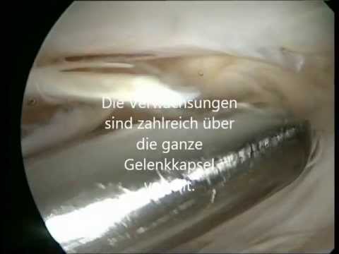 Schmerzen in der rechten Seite des Rückens und Übelkeit Schultergelenk Schmerzen Verstauchung