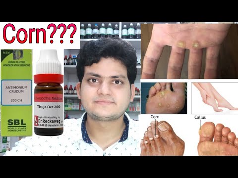 Corn! Homeopathic medicine for corn?? corn on foot corn on finger corn on hand!! explain! Video