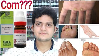 Corn! Homeopathic medicine for corn?? corn on foot corn on finger corn on hand!! explain!