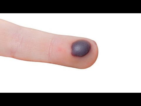 Blood Blisters video