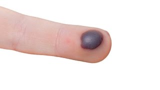 How to get Rid of Blood Blisters