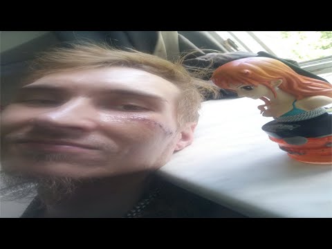 1.St Day with Luffy Scar under my right eye stitches removed! Happy Fan!【Shades Finnish Pirates】