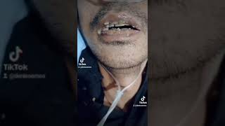 Download lagu Pasien HIV dengan Kandidiasis oral   TB Paru mp3 Download lagu Pasien HIV dengan Kandidiasis oral   TB Paru mp3