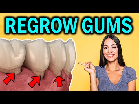 How to Regrow Receding Gums Naturally (Reverse Gum Recession without Surgery)
