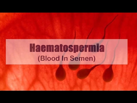 Hemospermia (vér a spermában) - okok, diagnózis, kezelés