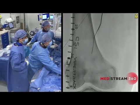 Endovascular Treatment of Right Popliteal Artery CTO and Right SFA ISR