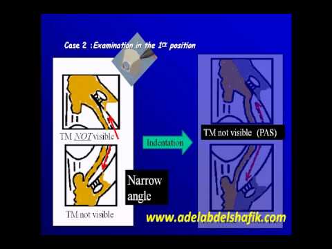 Gonioscopy Lecture Part 5