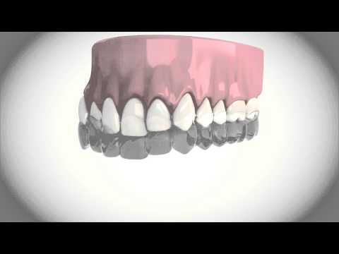 IAS Academy: ClearSmile Aligner
