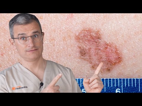 Weißer Hautkrebs: wie erkennen? Wichtige Hinweise und Merkmale. Dr. med. Robert Kasten