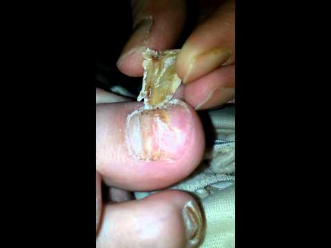 Clotrimazole cream ay hindi makatulong ang halamang-singaw ng paa Chinese pamahid para sa fungus paa
