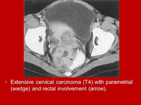 Whole Body Computed Tomography Female Pelvis video book lecture