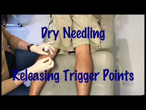 ドライニードリング (Dry Needling)