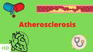 Atherosclerosis, Causes, Signs and Symptoms, Diagnosis and Treatment.