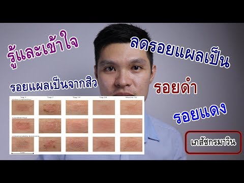 โรคผิวหนังภูมิแพ้ suprastin ในผู้ใหญ่ โรคสะเก็ดเงินและการตอบสนองต่อความหนาวเย็น